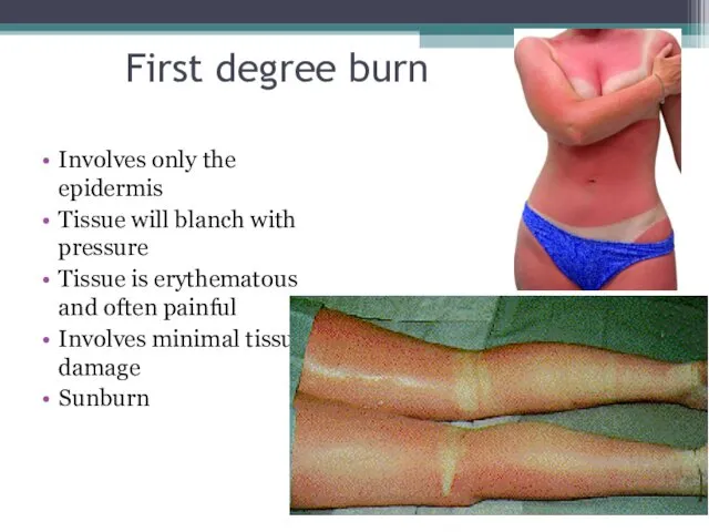 First degree burn Involves only the epidermis Tissue will blanch