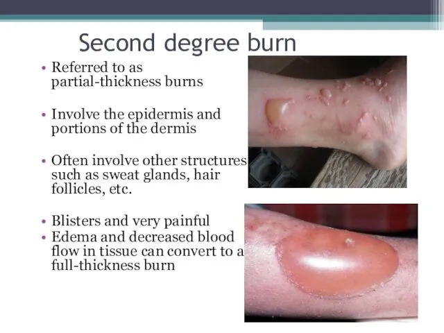 Second degree burn Referred to as partial-thickness burns Involve the