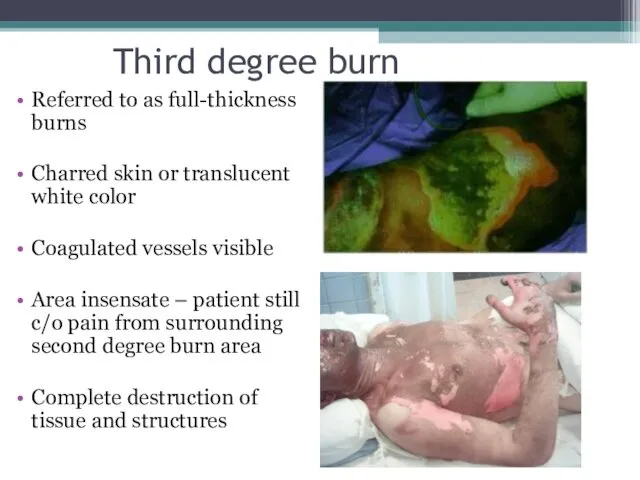 Third degree burn Referred to as full-thickness burns Charred skin