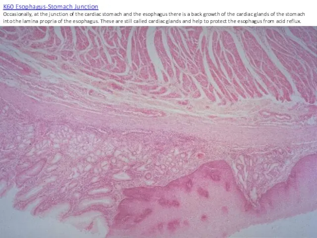 K60 Esophagus-Stomach Junction Occasionally, at the junction of the cardiac