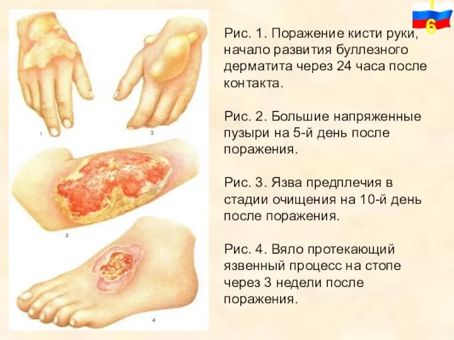 Рис. 1. Поражение кисти руки, начало развития буллезного дерматита через