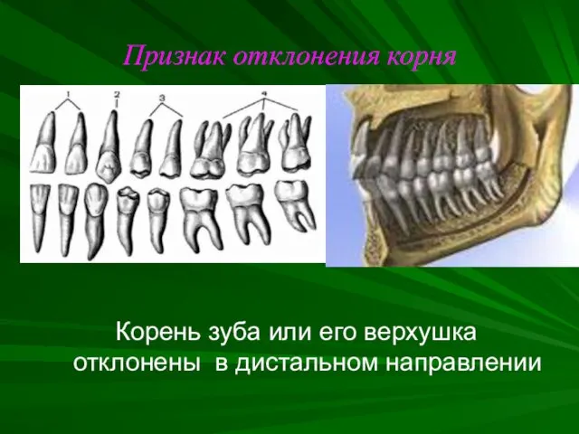 Признак отклонения корня Корень зуба или его верхушка отклонены в дистальном направлении