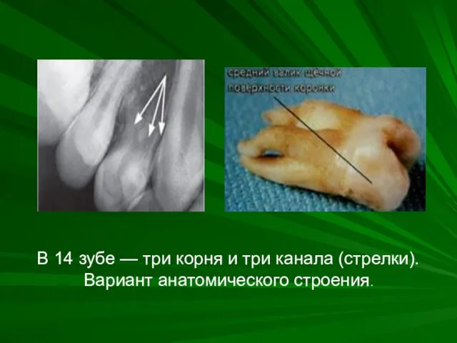 . В 14 зубе — три корня и три канала (стрелки). Вариант анатомического строения.