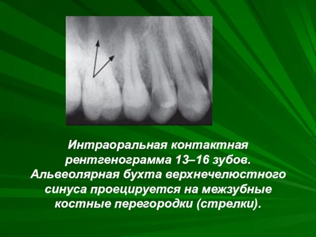 Интраоральная контактная рентгенограмма 13–16 зубов. Альвеолярная бухта верхнечелюстного синуса проецируется на межзубные костные перегородки (стрелки).