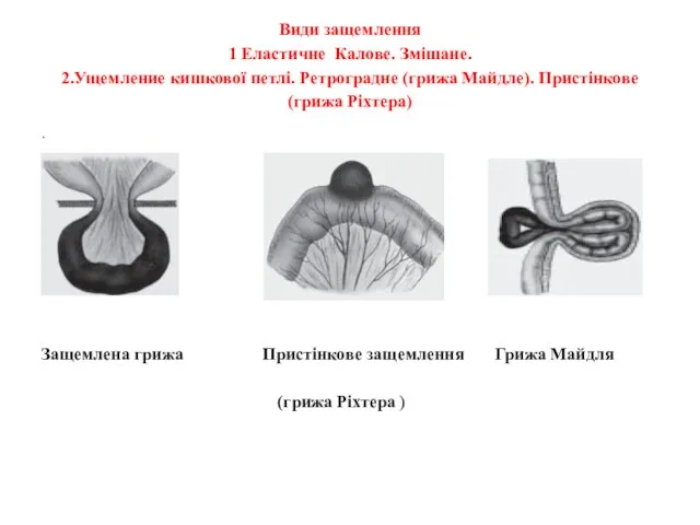 Види защемлення 1 Еластичне Калове. Змішане. 2.Ущемление кишкової петлі. Ретроградне