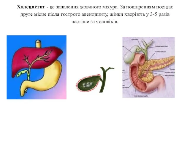 Холецистит - це запалення жовчного міхура. За поширенням посідає друге