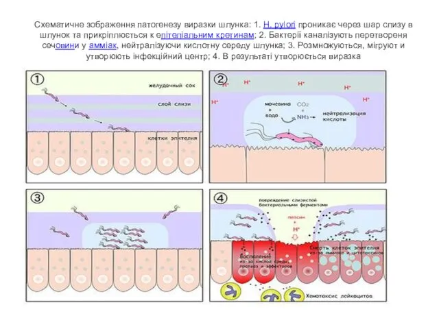 Схематичне зображення патогенезу виразки шлунка: 1. H. pylori проникає через