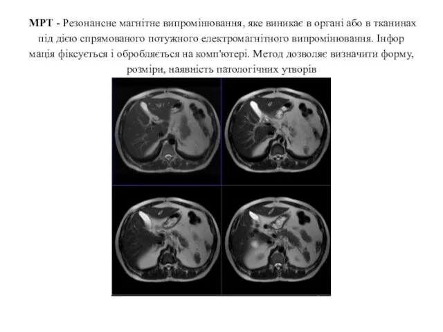 МРТ - Ре­зонансне магнітне випромінювання, яке виникає в органі або