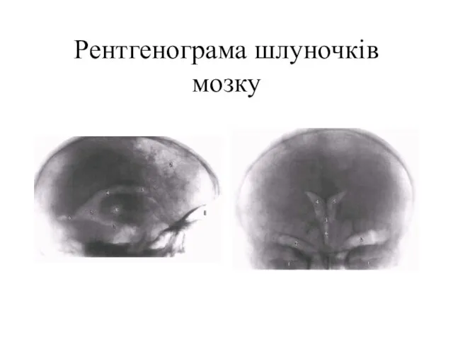 Рентгенограма шлуночків мозку