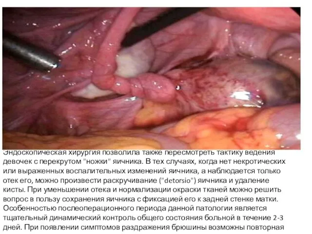 Эндоскопическая хирургия позволила также пересмотреть тактику ведения девочек с перекрутом