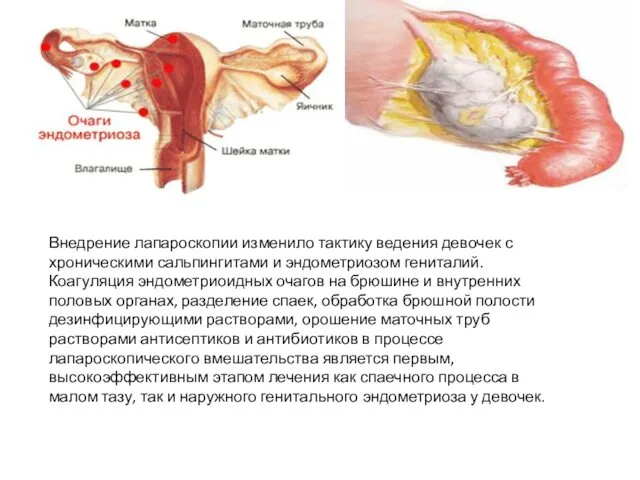 Внедрение лапароскопии изменило тактику ведения девочек с хроническими сальпингитами и