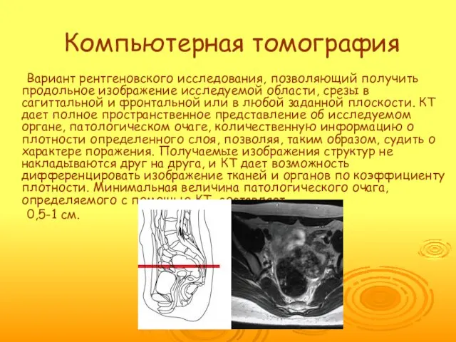 Компьютерная томография Вариант рентгеновского исследования, позволяющий получить продольное изображение исследуемой