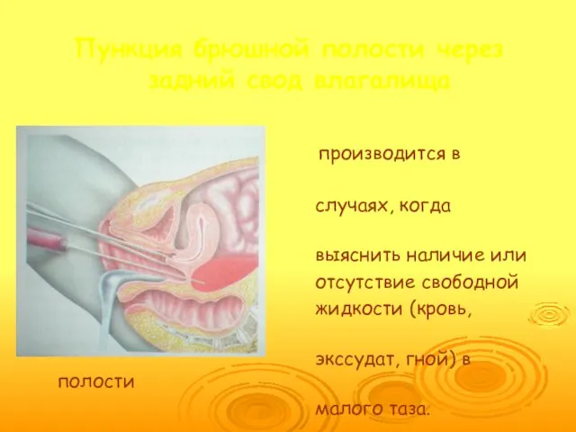 Пункция брюшной полости через задний свод влагалища производится в стационаре в случаях, когда