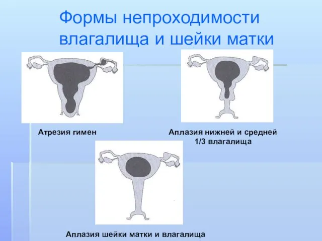 Формы непроходимости влагалища и шейки матки Атрезия гимен Аплазия шейки