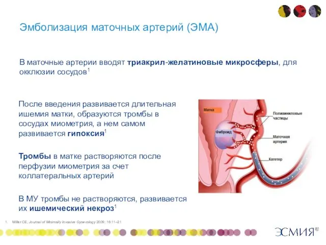 В маточные артерии вводят триакрил-желатиновые микросферы, для окклюзии сосудов1 Miller