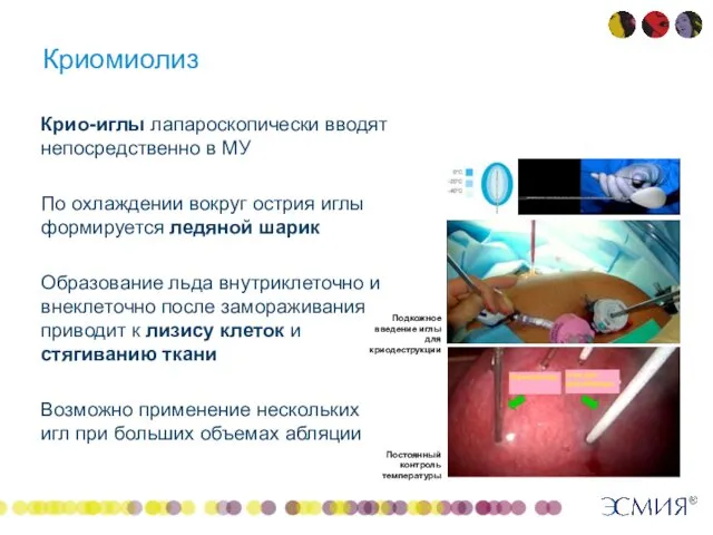 Криомиолиз Крио-иглы лапароскопически вводят непосредственно в МУ По охлаждении вокруг