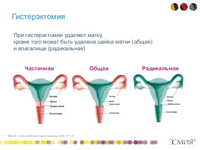 Гистерэктомия Miller CE, Journal of Minimally Invasive Gynecology 2009; 16:11–21