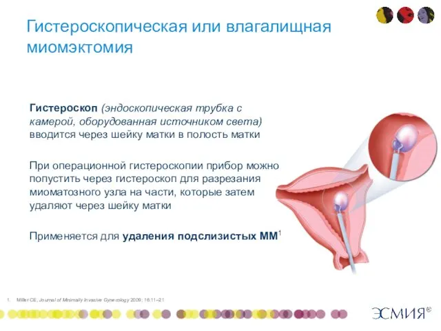 Гистероскопическая или влагалищная миомэктомия Гистероскоп (эндоскопическая трубка с камерой, оборудованная