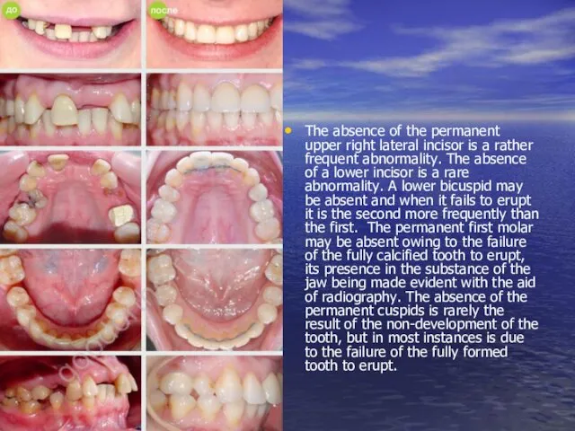 The absence of the permanent upper right lateral incisor is