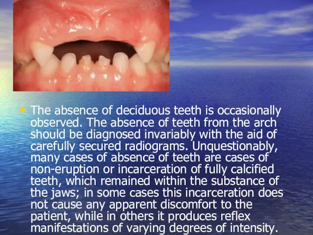 The absence of deciduous teeth is occasionally observed. The absence