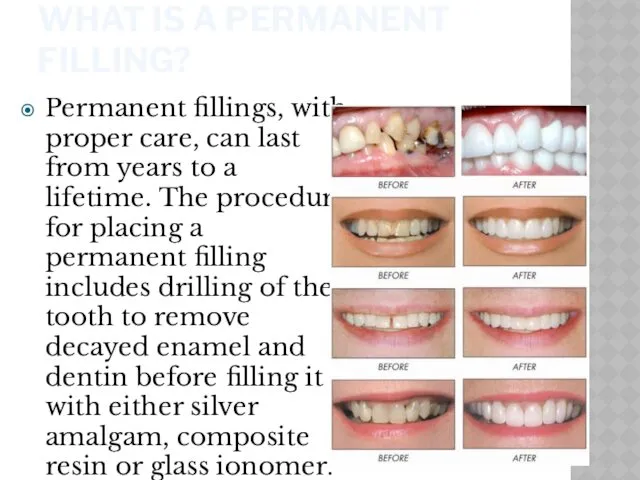 WHAT IS A PERMANENT FILLING? Permanent fillings, with proper care,