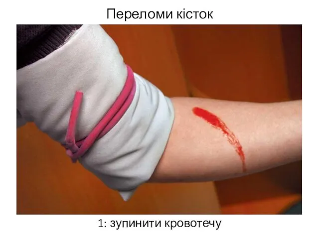 Переломи кісток 1: зупинити кровотечу