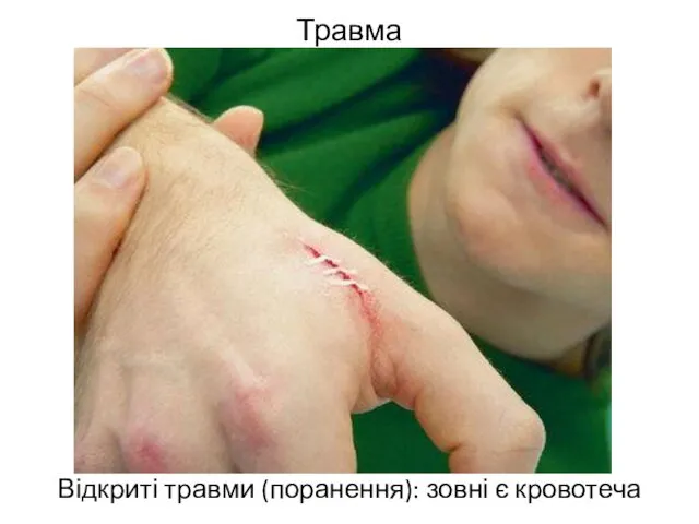 Травма Відкриті травми (поранення): зовні є кровотеча