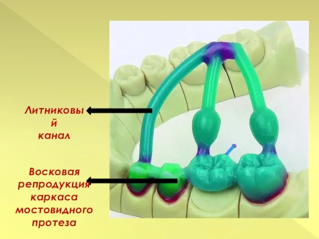 Восковая репродукция каркаса мостовидного протеза Литниковый канал