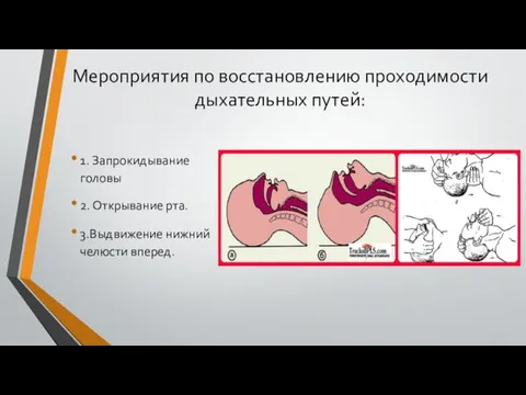 Мероприятия по восстановлению проходимости дыхательных путей: 1. Запрокидывание головы 2. Открывание рта. 3.Выдвижение нижний челюсти вперед.