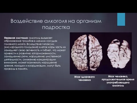 Воздействие алкоголя на организм подростка Нервная система: алкоголь вызывает образование