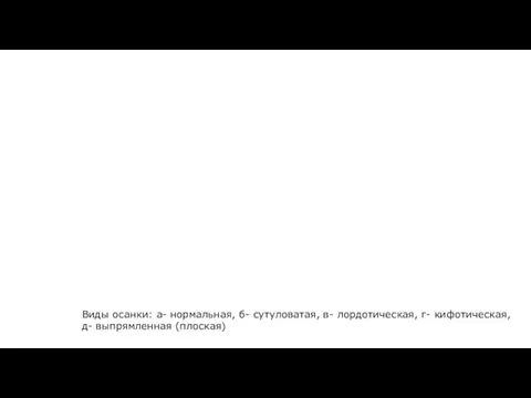 Виды осанки: а- нормальная, б- сутуловатая, в- лордотическая, г- кифотическая, д- выпрямленная (плоская)