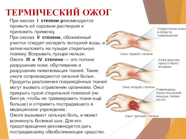 ТЕРМИЧЕСКИЙ ОЖОГ При ожогах I степени рекомендуется промыть её содовым