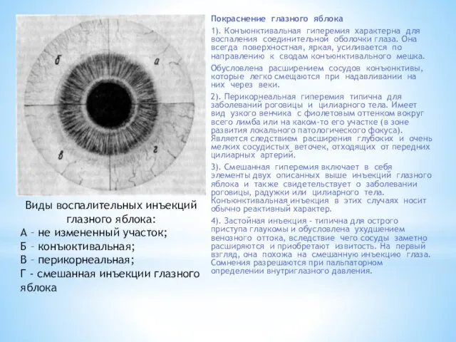 Покраснение глазного яблока 1). Конъюнктивальная гиперемия характерна для воспаления соединительной