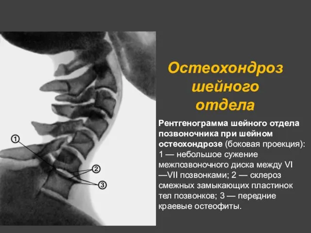 Рентгенограмма шейного отдела позвоночника при шейном остеохондрозе (боковая проекция): 1