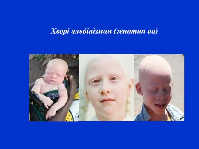 Хворі альбінізмом (генотип аа)