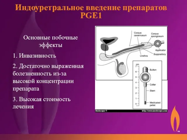 Индоуретральное введение препаратов PGE1 Основные побочные эффекты 1. Инвазивность 2.