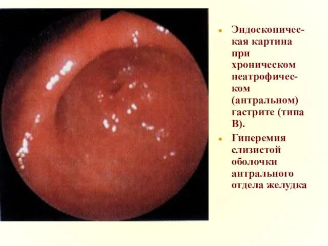 Эндоскопичес-кая картина при хроническом неатрофичес-ком (антральном) гастрите (типа В). Гиперемия слизистой оболочки антрального отдела желудка
