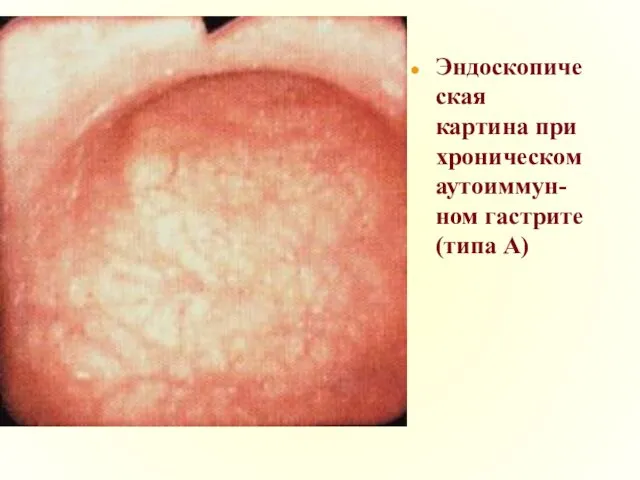 Эндоскопическая картина при хроническом аутоиммун-ном гастрите (типа А)