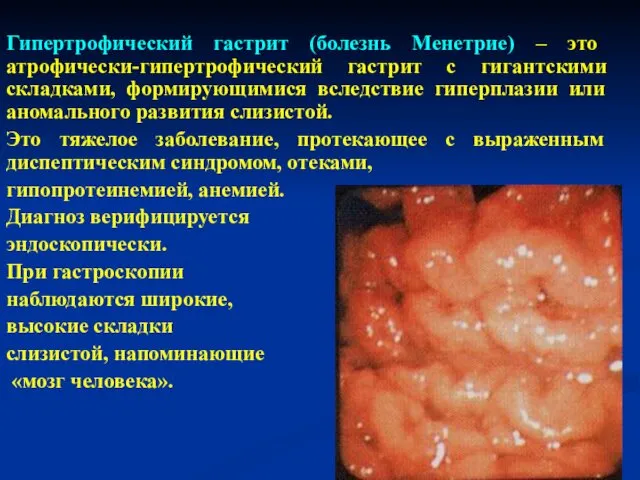 Гипертрофический гастрит (болезнь Менетрие) – это атрофически-гипертрофический гастрит с гигантскими