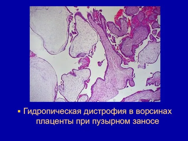 Гидропическая дистрофия в ворсинах плаценты при пузырном заносе