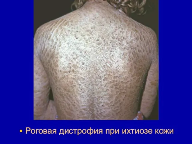 Роговая дистрофия при ихтиозе кожи