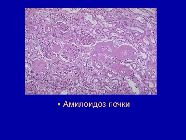 Амилоидоз почки