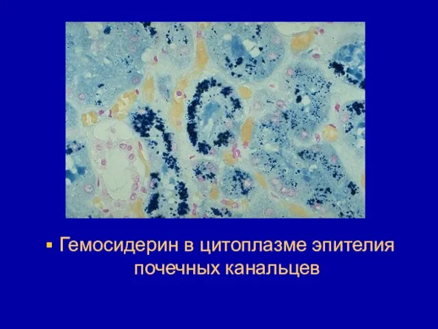Гемосидерин в цитоплазме эпителия почечных канальцев