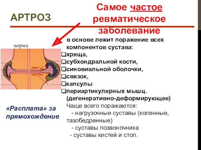 АРТРОЗ норма Самое частое ревматическое заболевание в основе лежит поражение