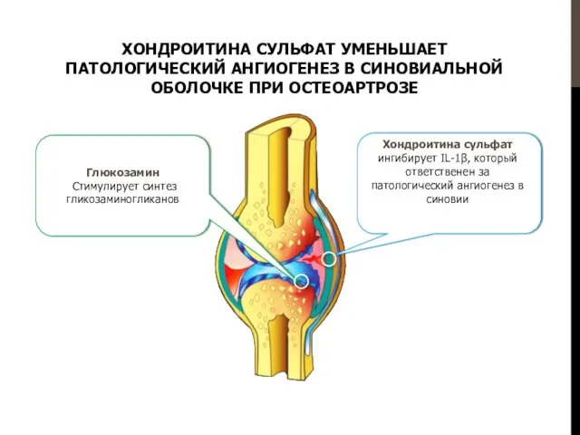 ХОНДРОИТИНА СУЛЬФАТ УМЕНЬШАЕТ ПАТОЛОГИЧЕСКИЙ АНГИОГЕНЕЗ В СИНОВИАЛЬНОЙ ОБОЛОЧКЕ ПРИ ОСТЕОАРТРОЗЕ Глюкозамин Стимулирует синтез