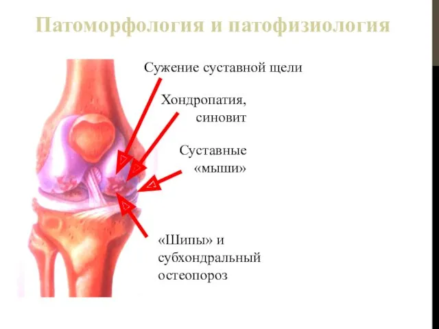 Хондропатия, синовит «Шипы» и субхондральный остеопороз Сужение суставной щели Патоморфология и патофизиология Суставные «мыши»