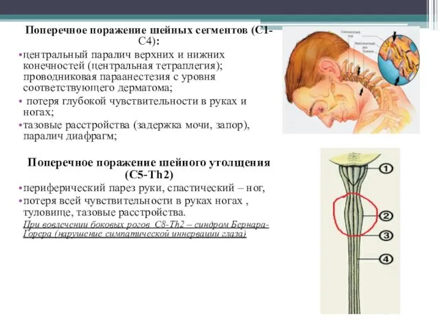 Поперечное поражение шейных сегментов (С1-С4): центральный паралич верхних и нижних