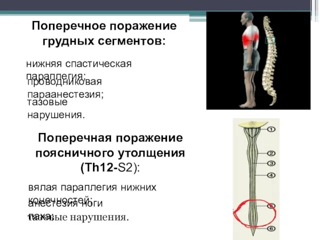 тазовые нарушения. Поперечное поражение грудных сегментов: нижняя спастическая параплегия; проводниковая