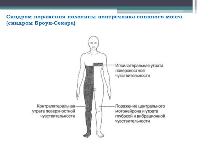 Синдром поражения половины поперечника спинного мозга (синдром Броун-Секара)