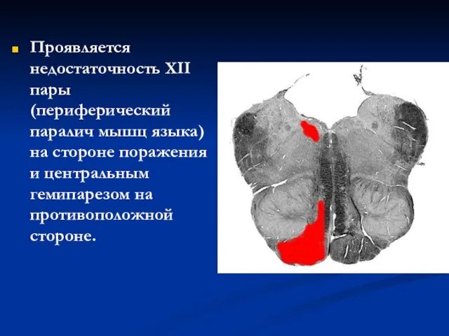 Проявляется недостаточность XII пары (периферический паралич мышц языка) на стороне